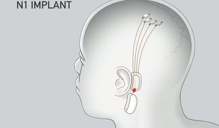 Elon Musk Neuralink chip got the FDA's approval; now the brain will be controlled with a chip